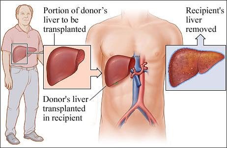 liver transplant rejection
